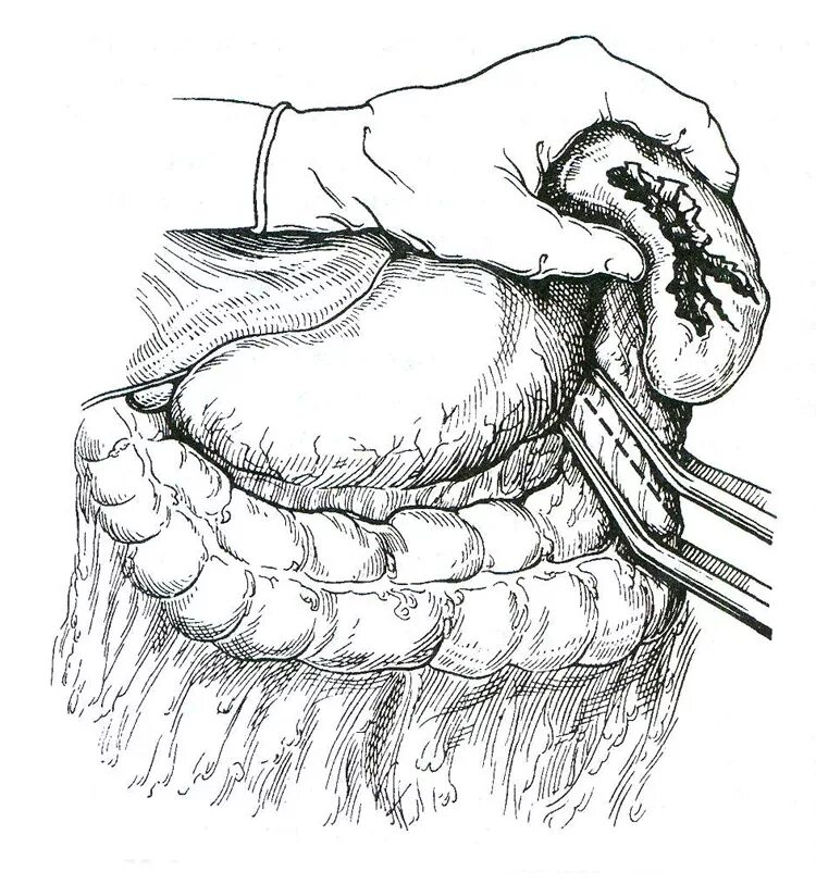 Спленэктомия что это. Ушивание РАН селезенки. Ушивание РАН поджелудочной железы-. Спленэктомия операция. Ушивание раны селезенки.