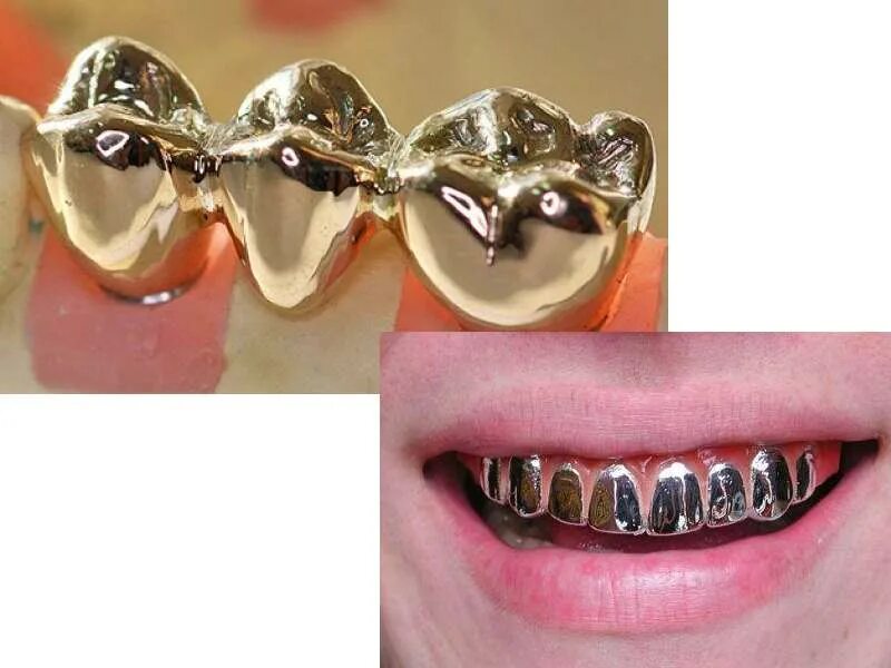 Сколько стоит металлические зубы. МЗП цирконий коронка. Металлическая коронка. Штампованная металлическая коронка. Металлические коронки для зубов.