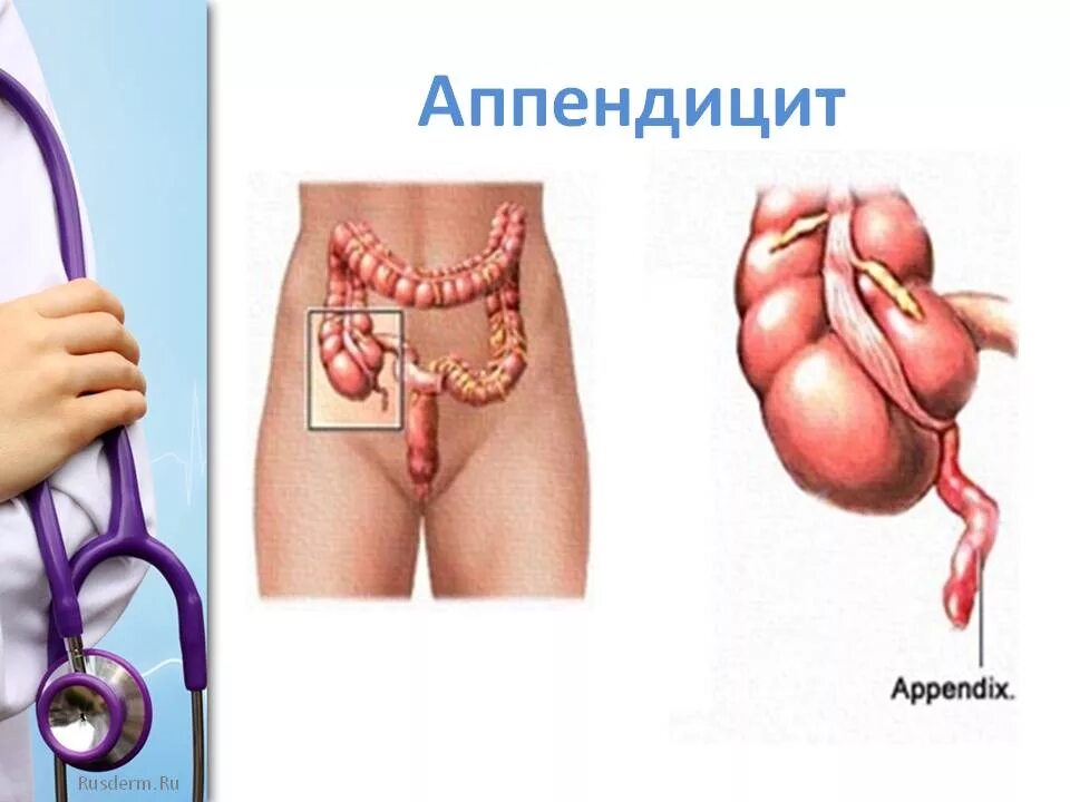 Аппендикулярный аппендицит. Где находится аппендицит.