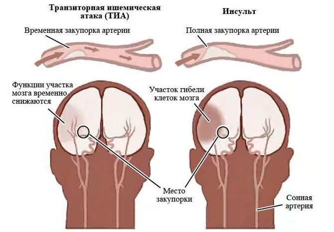 Транзиторная ишемия мозга. Транзиторная ишемическая атака головного мозга. Транзиторные ишемические атаки. Тиа и ишемический инсульт.