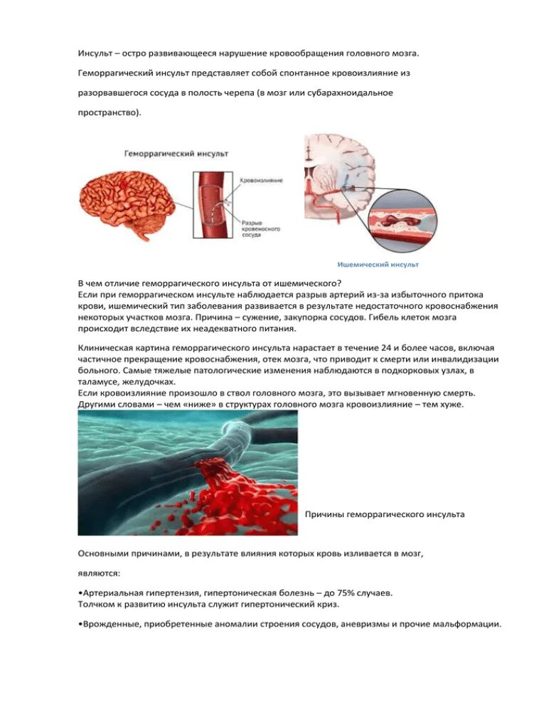 Был геморрагический инсульт. Геморрагический инсульт микроскопия. Геморрагический инсульт головного мозга. Клиника геморрагического инсульта головного мозга. Геморрагический инсульт причины.
