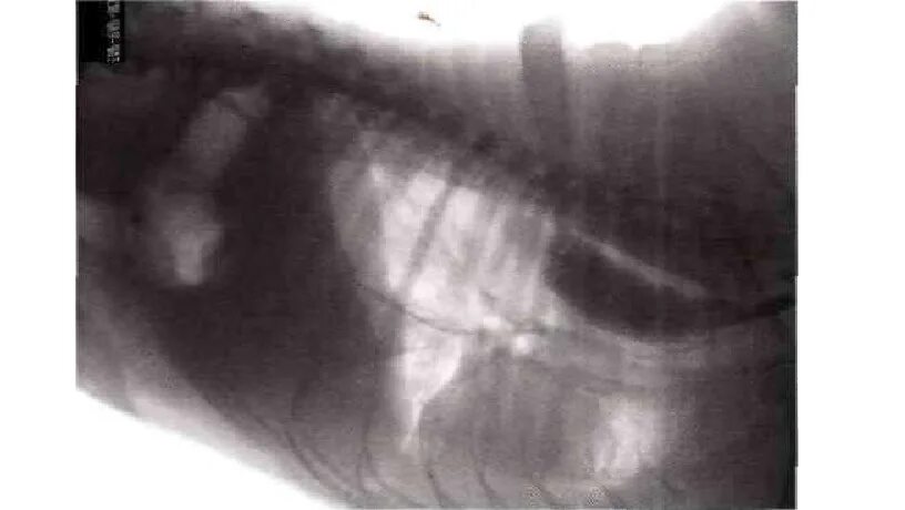 Рентген задержка контраста в пищеводе. Мегаэзофагус при незакрытом артериальном протоке. Осмотр пищевода