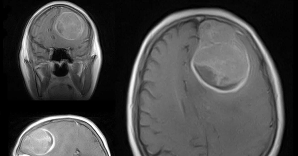 Опухоли теменной. Глиома лобной доли мрт. Глиобластома лобной доли головного мозга. Глиобластома головного мозга мрт. Глиобластома метастазирует?.