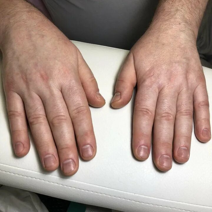 Как выглядят мужские руки Hand Veins Macon Vein Specialists of the South