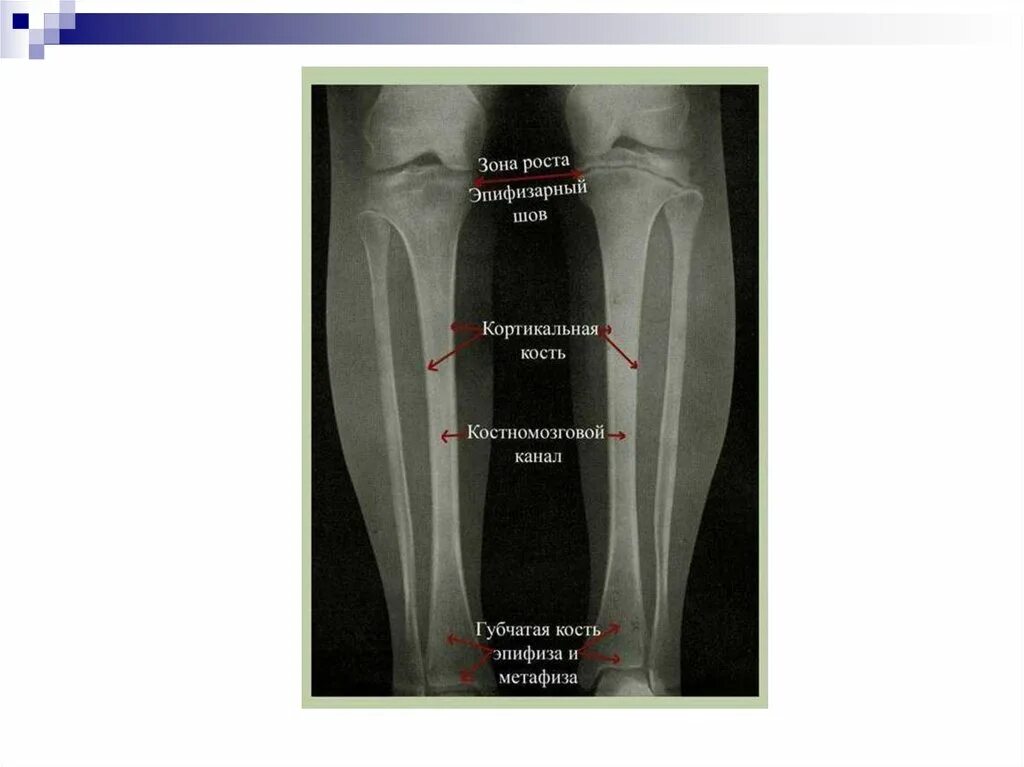 Зоны роста. Эпифизарные зоны роста. Зоны роста костей.