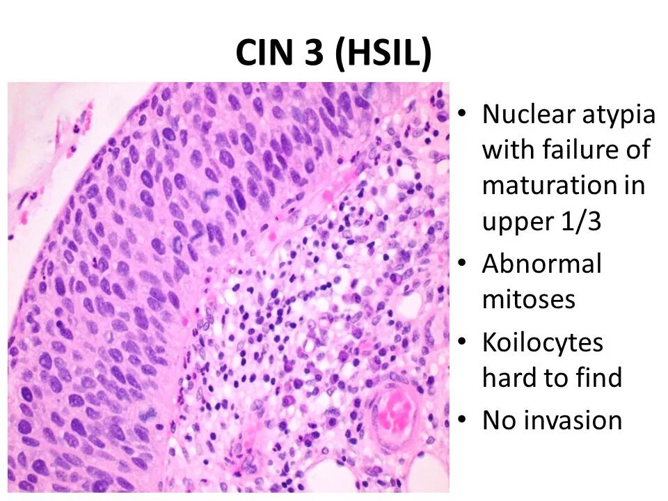 Cin 1 шейки. Дисплазия шейки матки hsil cin3. cin 1 шейки матки. гистология.