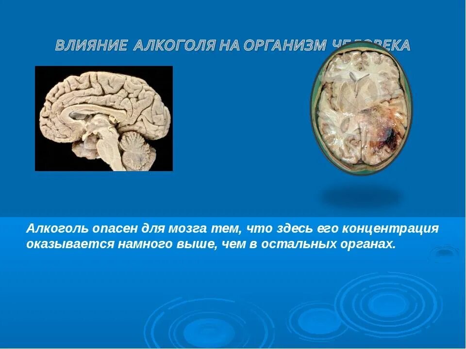 Факторы влияющие на мозг. Мозг алкоголика и здорового человека. Мозг нормального человека и алкоголика.