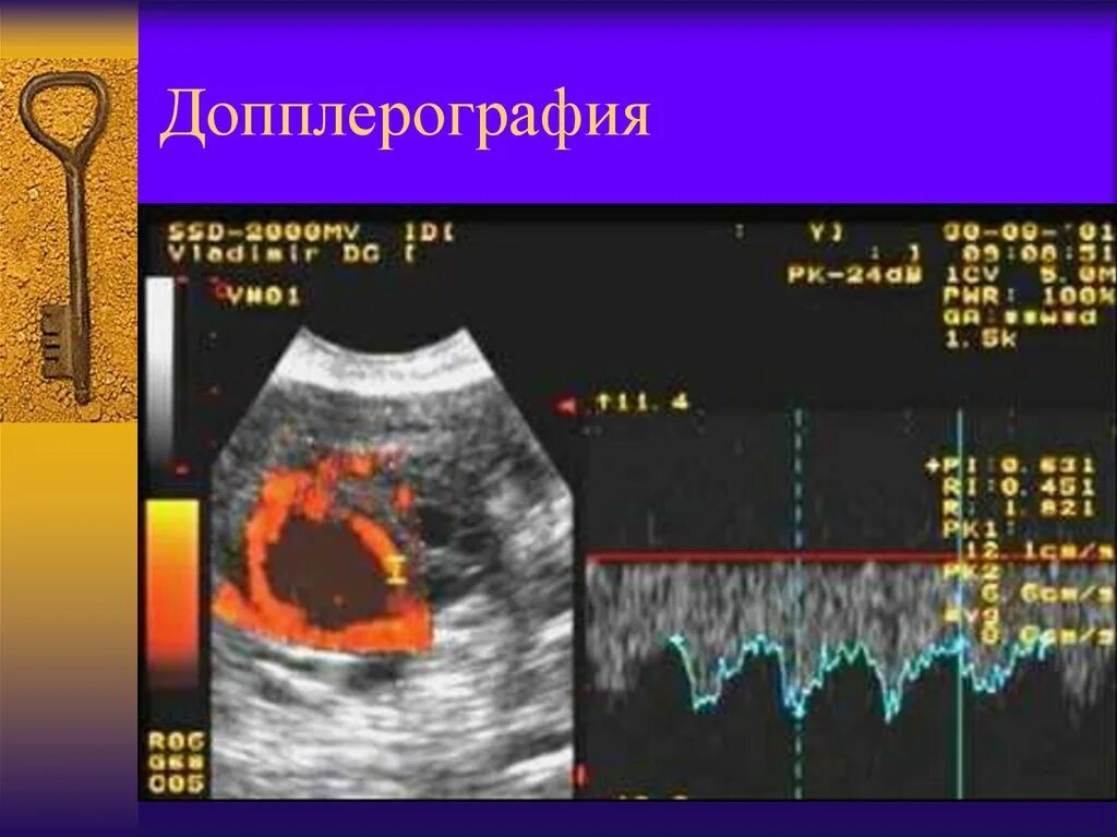 Что такое уздг. Допплерография принцип метода. Ультразвуковая допплерометрия. УЗИ допплерография. Допплерография в гинекологии.