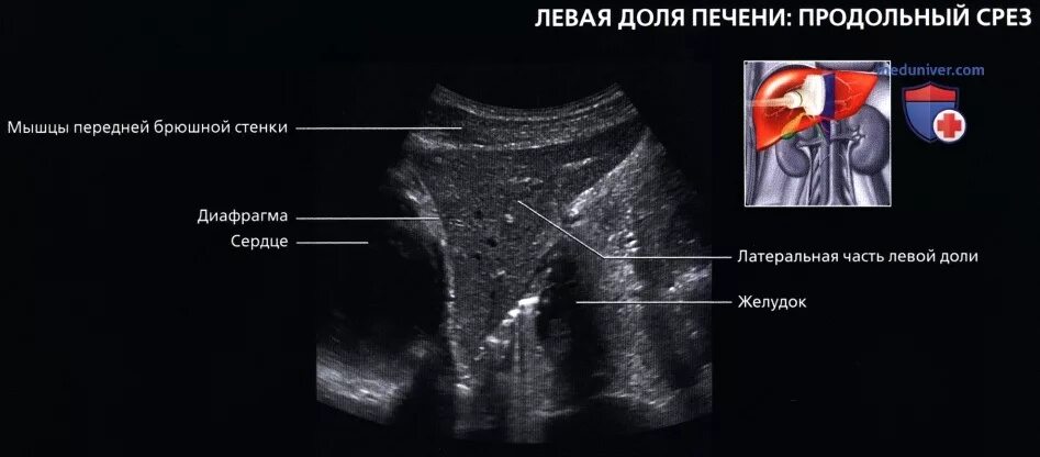 Продольное сканирование печени на УЗИ. Продольное изображение левой доли печени. Ультразвуковая анатомия печени сегменты. Узи печени схема
