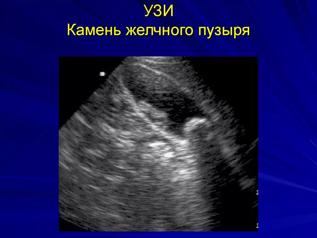 Узи жкб. УЗИ желчного пузыря желчекаменная болезнь. УЗИ желчного пузыря желчнокаменная болезнь. ЖКБ конкременты желчного пузыря УЗИ. Конкременты желчного пузыря при ультразвук.