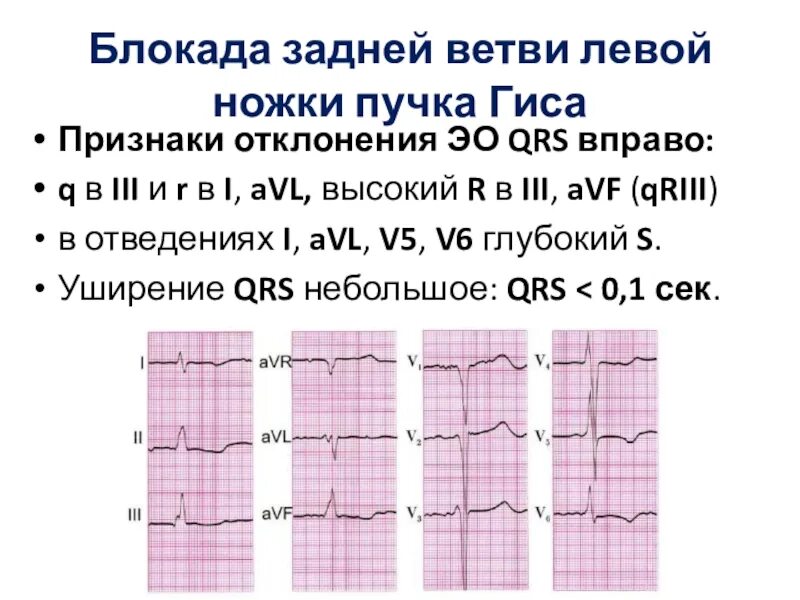Блокада передней ножки пучка гиса на экг. Блокада задней ветви лнпг на экг. Блокада передней ветви левой ножки на экг. Блокада передней ветви лнпг на экг. Экг при блокаде задней ветви левой ножки пучка гиса.