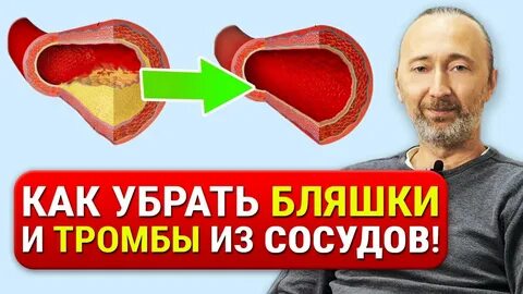 Как чистить тромбы