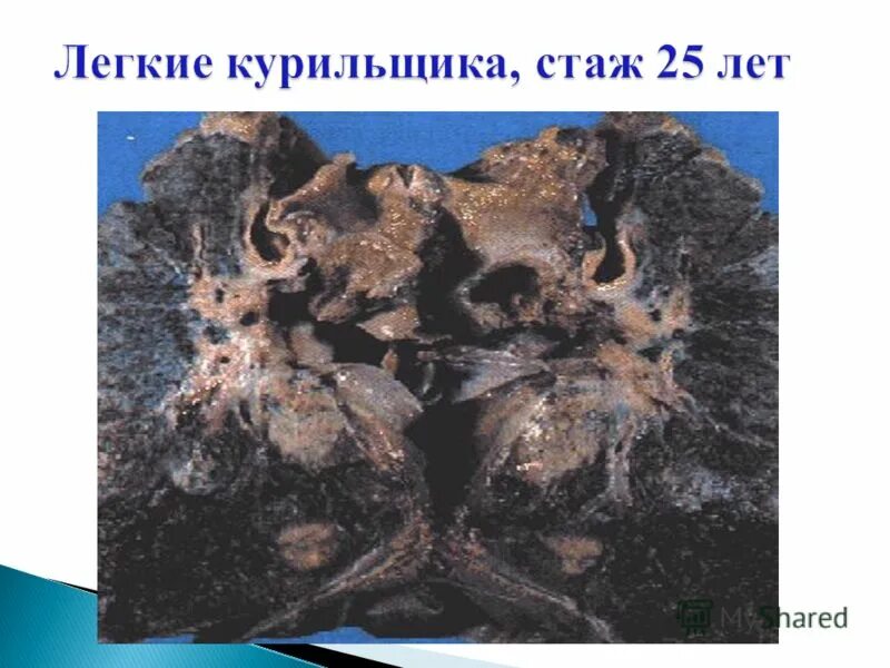 Легкие курильщика 25 лет. Как бросить курить 1 год стажа. Лёгкие курильщика с разным стажем. Как бросить курить стаж 2 года. Курил 30 лет.