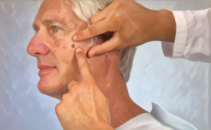 Актинический кератоз фото лечение Advanced age need not deter surgery for cutaneous tumors Science Media Eczema tr