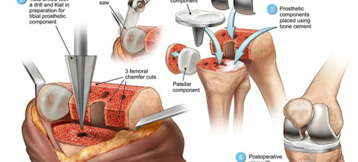 Операция по замене коленного сустава. Замена коленного сустава по квоте. Форум операции по замене суставов