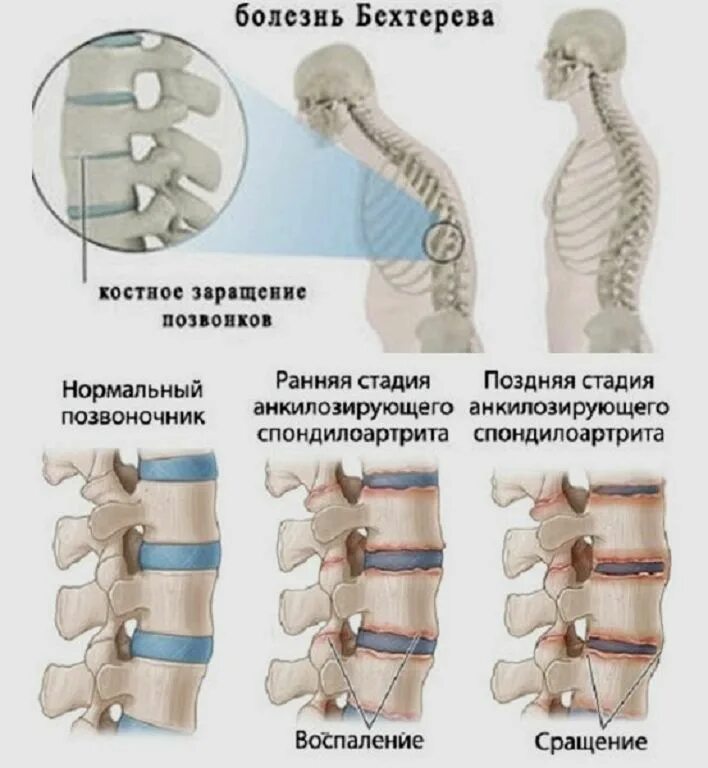 Бехтеревка. Анкилозирующий спондилит Бехтерева. Анкилозирующий спондилит (болезнь Бехтерева) эпидемиология. Анкилозирующий спондилит синдесмофиты. Болезнь Бехтерева поясничный отдел позвоночника.