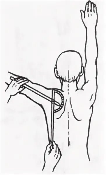 Контрактура плечевого сустава ЛФК. Внутриротационная контрактура плечевого сустава. ЛФК при контрактуре плечевого сустава после перелома. Посттравматическая контрактура правого плечевого сустава. Контрактура сустава после перелома