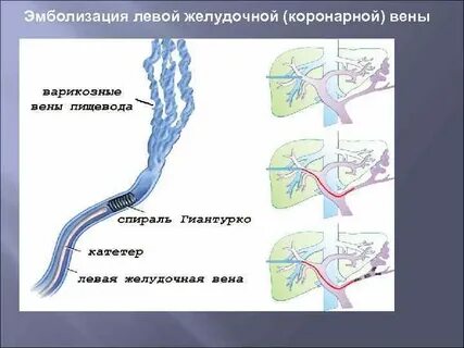 Эмболизация сосудов