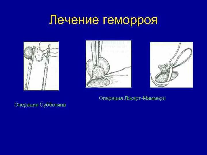 Лечение геморроя 2 стадии. Операция Локхарт-Маммери. Операция геморроя хирургическим.