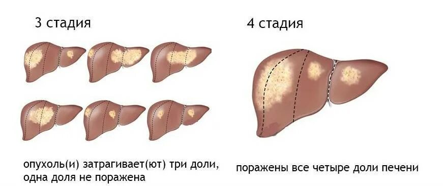 Что такое метастазы 4 степени печени. Опухоль печени 4 стадии. Карцинома печени 4 стадия.