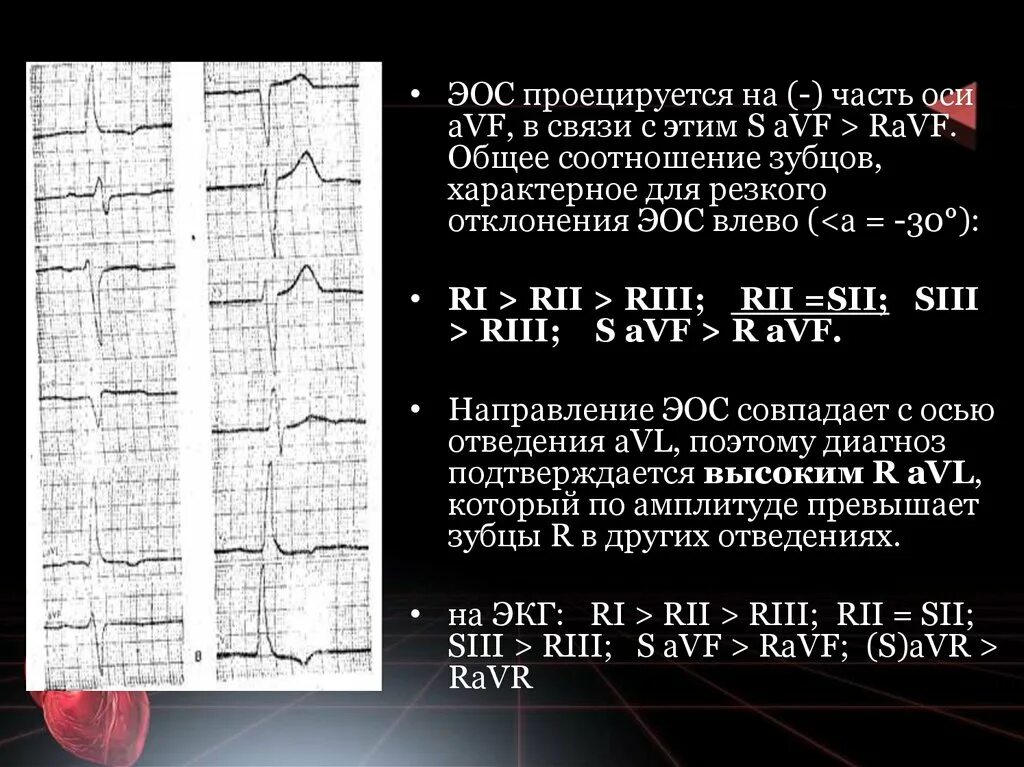 Электрическая ось сердца типа s1-s2-s3 на ЭКГ. Электрическая ось сердца s1-s2-s3. Отклонение ЭОС на ЭКГ. Электрическая ось вправо на ЭКГ. Сердце отклонено вправо