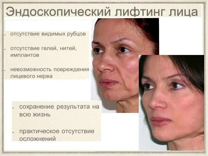 Подтяжка средней трети лица до и после Лифтинг лица в Иркутске, подтяжка лица
