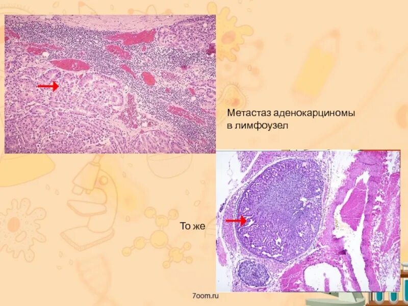 Метастазы в лимфоузлах при раке молочной. Метастазы в лимфоузлах микропрепарат. метастазы в лимфатическом узле микропрепарат. метастаз аденокарциномы в лимфатический узел микропрепарат. метастаз аденокарциномы микропрепарат.