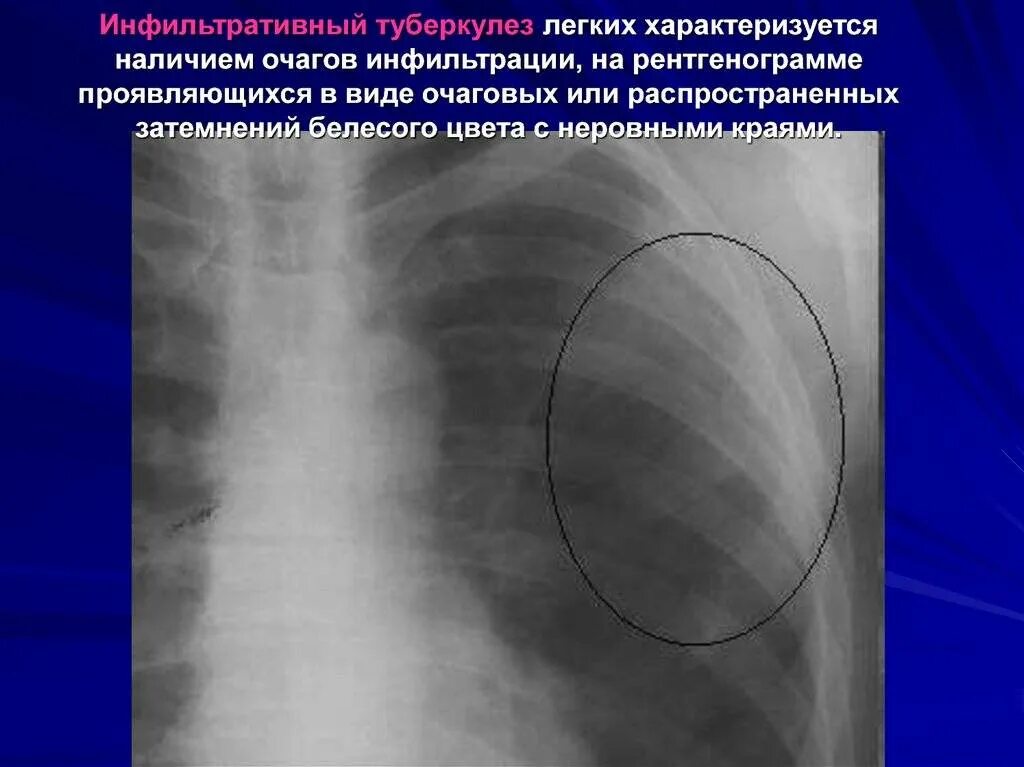 Туберкулез легких в фазе инфильтрации. Рентгенологические заключения инфильтративный туберкулеза. Бронхолобулярный инфильтрат рентген. Инфильтративный туберкулез рентгенография. Очагово-инфильтративный туберкулез рентген.