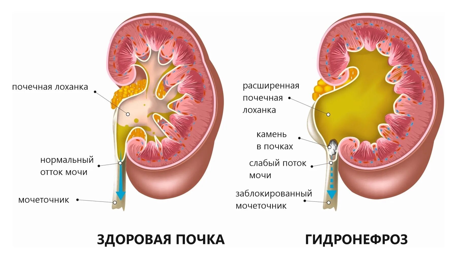 В почечных лоханках собирается. Гидронефротическая трансформация почки. Гидронефротическая трансформация ЧЛС почки. Гидрокаликоз почек. Гидрокаликоз левой почки на УЗИ.