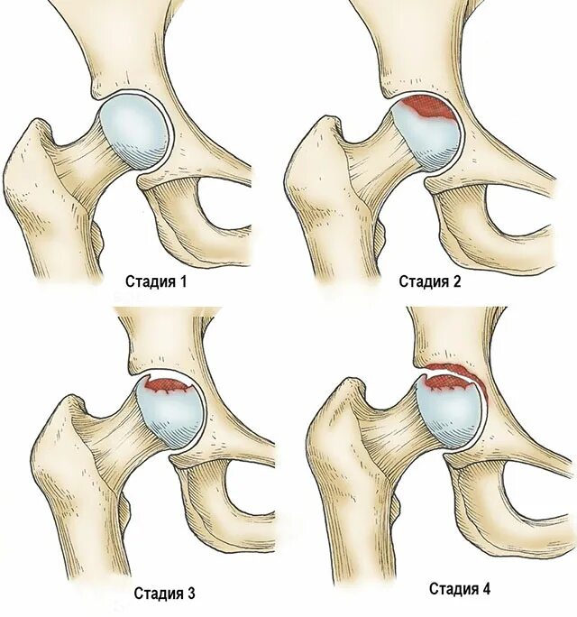 Степени некроза головки бедренной кости. Асептический некроз головки тазобедренного сустава стадии. Степени асептического некроза головки бедренной кости. Асептический некроз головки бедренной кости 2.