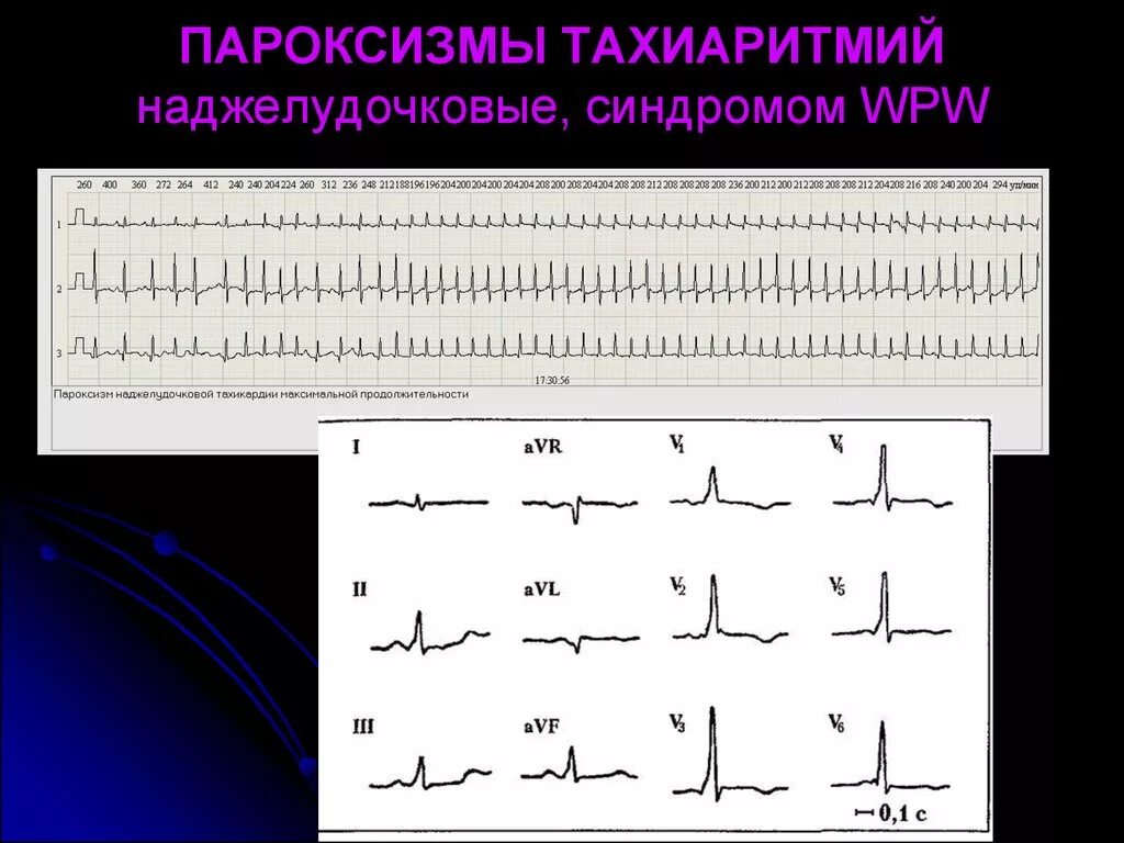 Пароксизм это простыми словами. Пароксизмальная тахиаритмия. Синдром wpw наджелудочковая. Классификация пароксизмальных тахиаритмий. Пароксизмы.