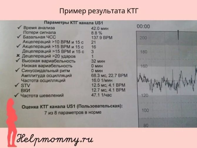 Сколько по времени делают ктг при беременности. Ктг плода при беременности расшифровка баллы. ктг интерпретация результатов. ктг при беременности 3 триместр плода. ктг показатель состояния.