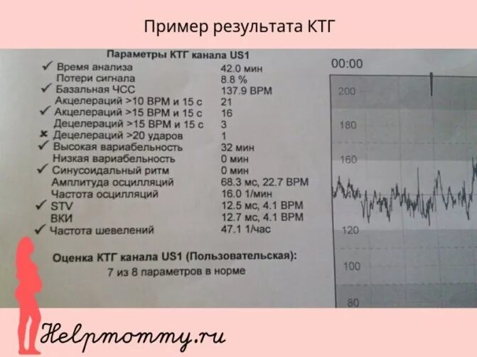 Исследование сердцебиения плода. КТГ при беременности 3 триместр плода. Показатели на аппарате КТГ. Расшифровка расшифровка КТГ. Оценка вариабельности КТГ.