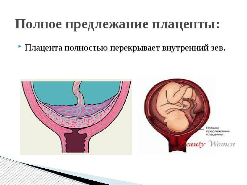 Плацента перекрывает область внутреннего зева. Плацента перекрывает внутренний зев 13 недель беременности. предлежание плаценты внутренний зев. перекрывает внутренний зев на 13 неделе беременности. хорион перекрывает внутренний зев.