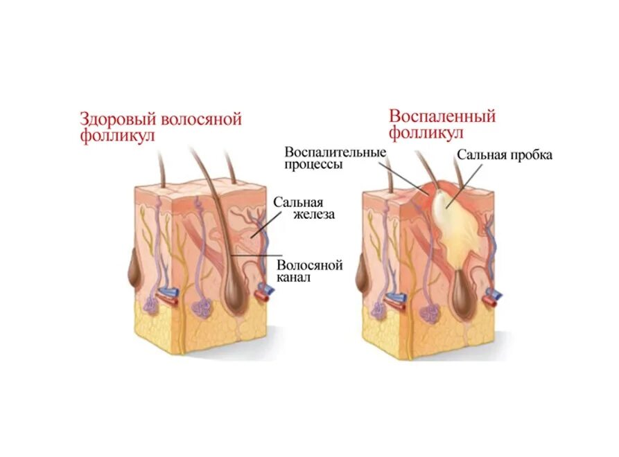 Фолликулит – воспаление волосяных фолликул.. Палисадный аппарат волосяного фолликула. Волосяной фолликул и сальная железа. Остиофолликулит и фолликулит.