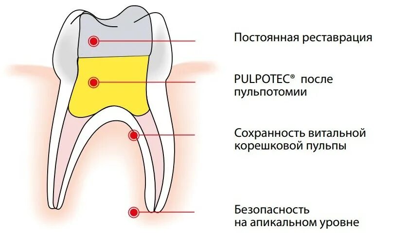 Витальная ампутация пульпы. Витальная ампутация пульпы Пульпотек. Этапы витальной экстирпации пульпы схема. Витальная экстирпация пульпы методика. Девитальная пульпотомия.