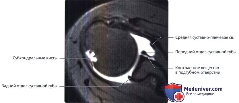 Дегенеративные изменения суставной губы. Разрыв суставной губы плечевого. Хрящевая суставная губа плечевого сустава. Дегенеративные изменения суставной губы. Фиброзно-хрящевая губа гленоида плечевого сустава.