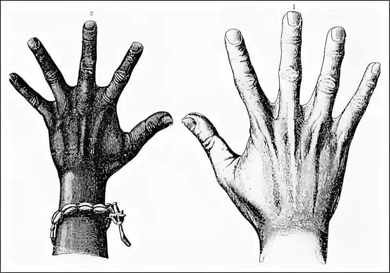 Перепонки на пальцах у людей. Перепонки между пальцев. Перепонки на ногах у людей. Перепонки на руках русалки. Перепонки между пальцами у человека.