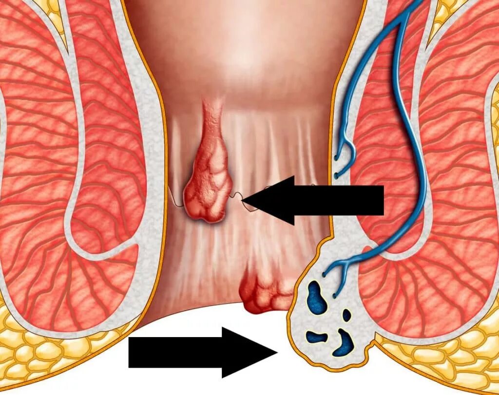 Боль в прямой кишке. Тромбоз внешнего геморроидального узла. Геморроидальный узел Вена.