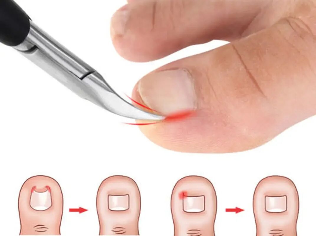 Типсы для наращивания. Онихокриптоз вросший ноготь. Как убрать кутикулу в домашних условиях. Как убрать кутикулу в домашних условиях. Подологический педикюр.