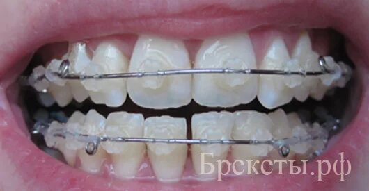поставить брекеты тверь. брекеты на верхние зубы металлические. лингвальные лигатурные брекеты. брекеты металлические micro arch. металлические лигатурные брекеты.