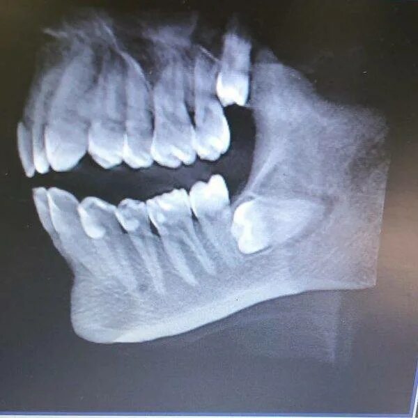 Ретинированный зуб мудрости рентген. Дистопированный зуб мудрости рентген. Ретинированный дистопированный зуб мудрости. Восьмерки сверху. Восьмерки сверху.