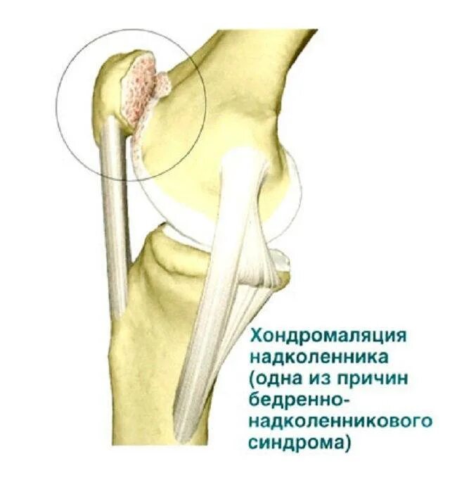 Латерализация надколенника. Степени хондромаляции надколенника. Хондромаляция надколенника коленного сустава. Хондромаляция надколенника Outerbridge. Хондромаляция надколенника надколенника.