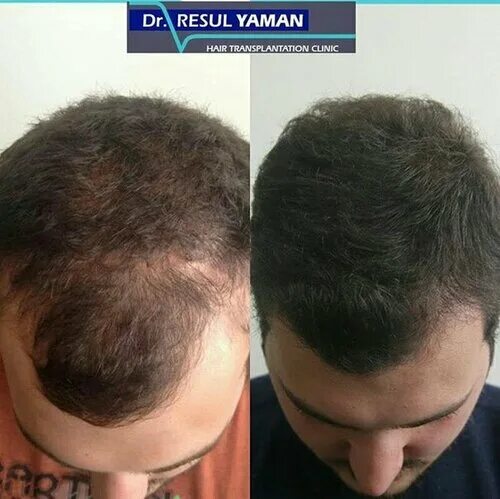 Пересадка волос в турции фото Результат пересадки 3000 графтов с затылка на голову HLC