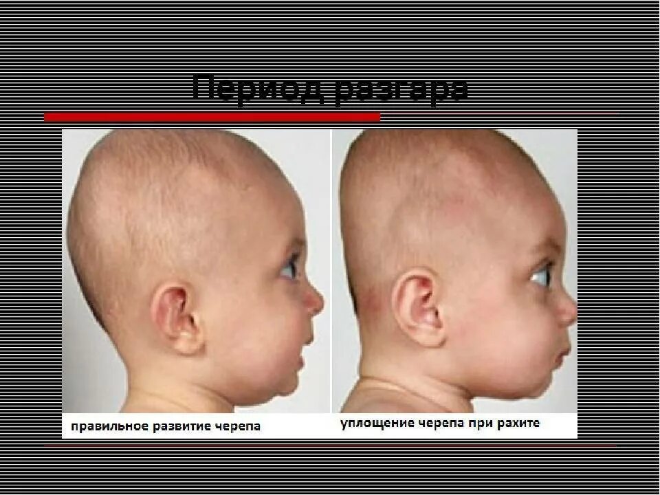 Замедлен рост головы. Рахит деформация черепа. деформация головы при рахите. изменение формы головы у новорожденного.