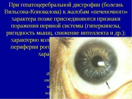 Болезнь вильсона