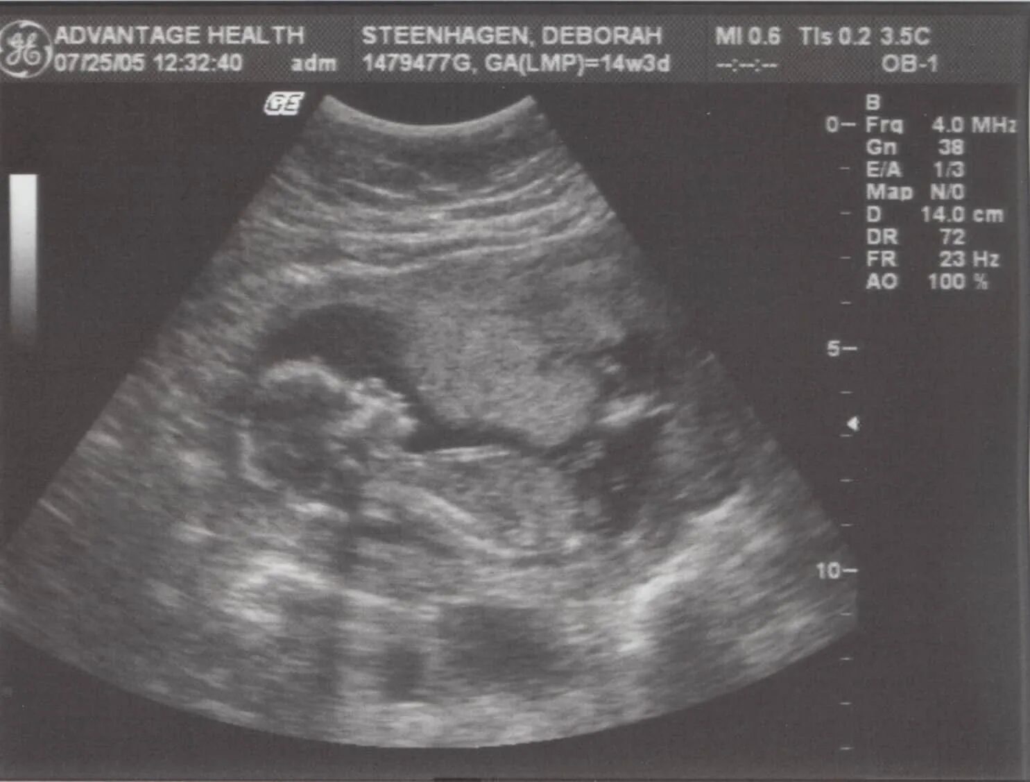 Узи первого триместра. УЗИ 2 Й триместр беременности. УЗИ 1 триместр беременности. Фото УЗИ 2 триместра беременности.