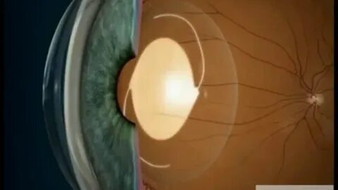 Хрусталик видео