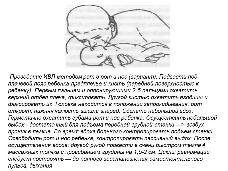 Способ рот в нос. ИВЛ методом "рот в нос" проводится:. Методика проведения ИВЛ рот в нос. Искусственная вентиляция легких (ИВЛ) рот в нос..