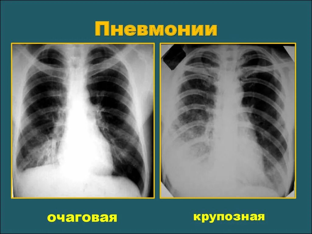 Апикальные плевральные наслоения рентген. Крупозная и очаговая пневмония. Пневмония на флюорографии. Пневмония на рентгене легких.
